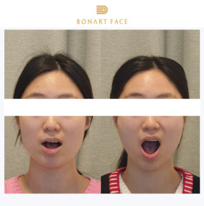 roi-loan-khop-thai-duong-ham