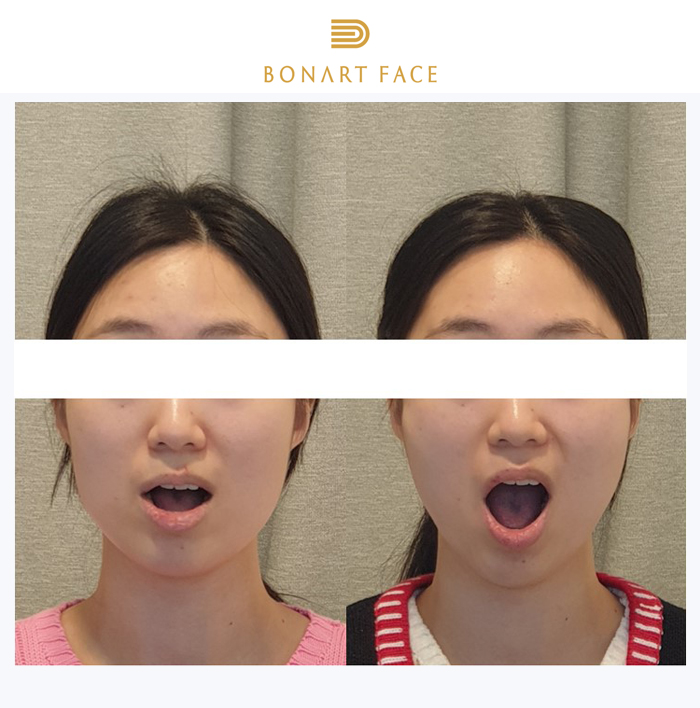 Lệch khớp thái dương hàm