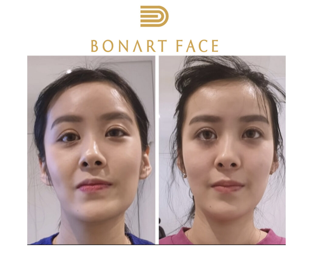 quy-trinh-nan-chinh-mat-bang-tay-bonart-face-vietnam