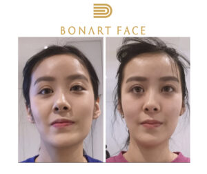 quy-trinh-nan-chinh-mat-bang-tay-bonart-face-vietnam