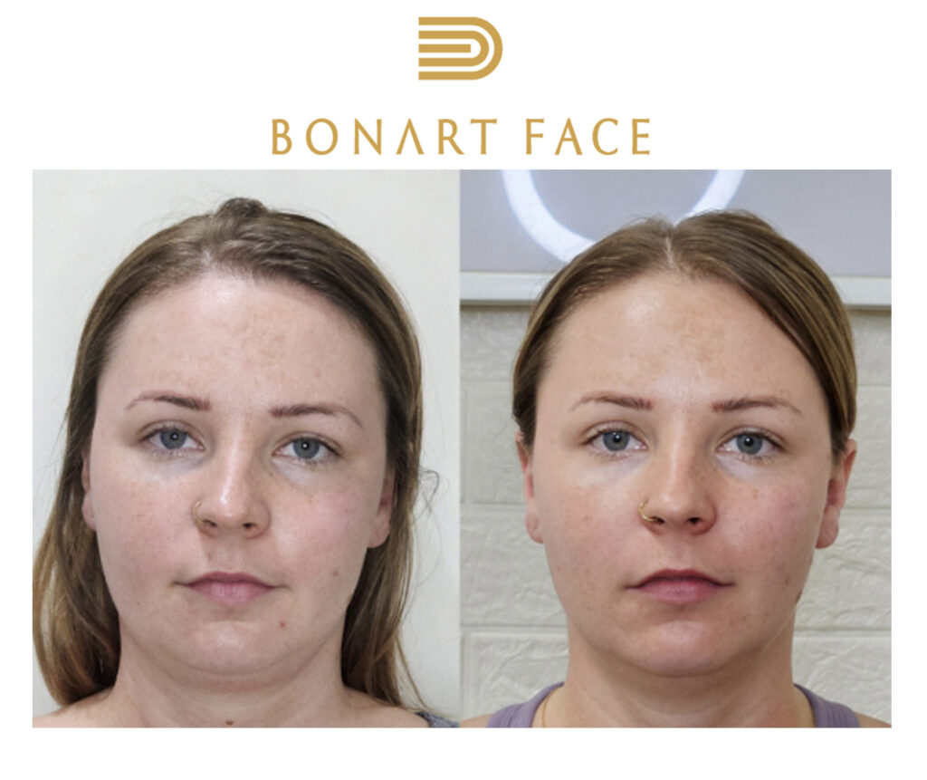 Bonartface-nan-chinh-mat-bang-tay 