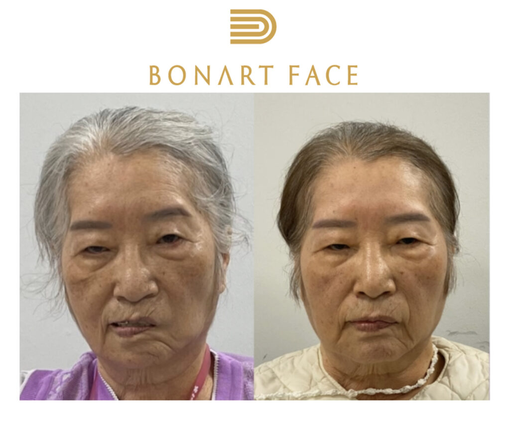 Bonart Face nắn chỉnh khuôn mặt bằng tay
