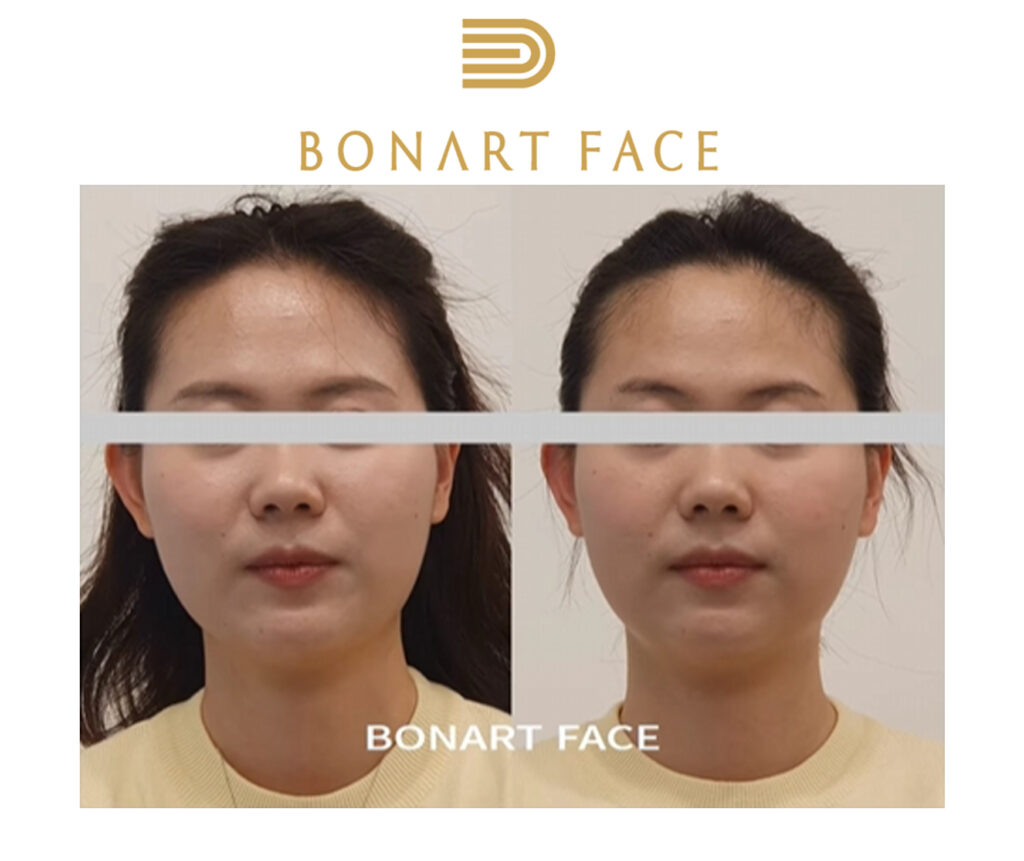 Mặt lệch khiến cho mặt bất đối xứng, già hơn so với tuổi