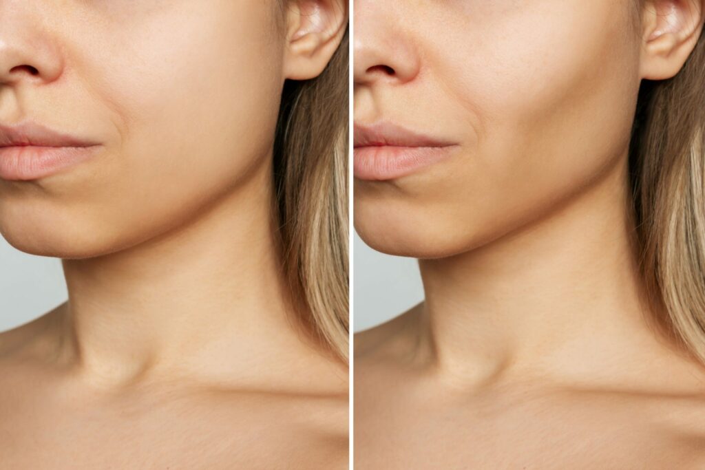 Nắn chỉnh mặt lệch Bonart Face