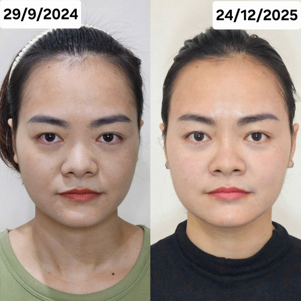 nan-chinh-khuon-mat-bang-tay-bonartface 
