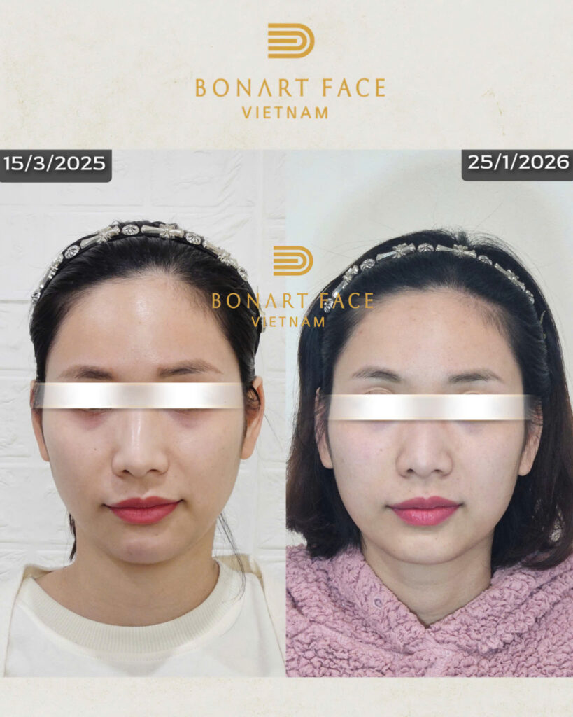 chị Phương Mai - Ninh Bình - sau 15 buổi - đỡ mặt lệch, mặt đỡ bị hóp, quắt, thái dương lõm hóp, miệng đỡ méo, gò má đỡ cao.