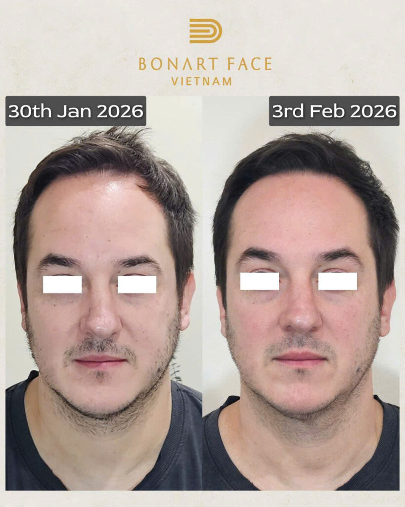 Đánh bay chóng mặt ù tai bằng bonartface