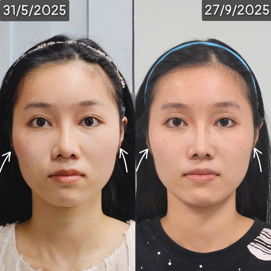 khach-hang-chinh-mat-bang-tay-bonart-face 