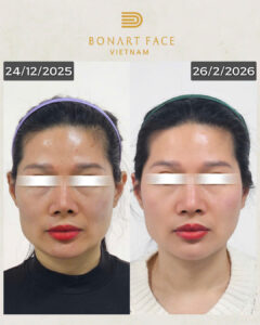 khach-hang-bonart-face-before-after