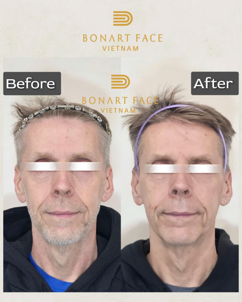 Review Nắn Mặt Bonart Face: Dứt Điểm 40 Năm Đau Nửa Đầu