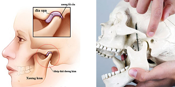 rối loạn khớp thái dương hàm cách chữa trị

