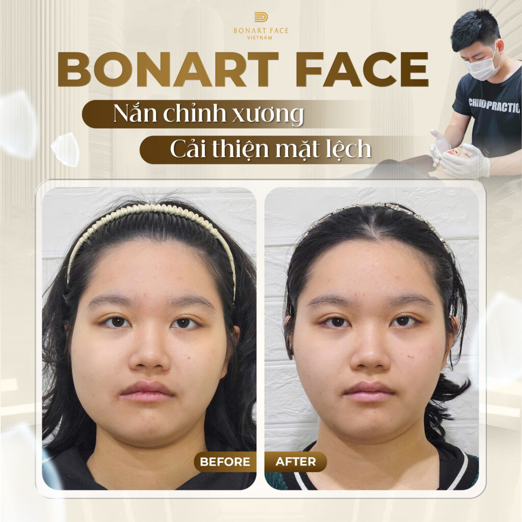 review nắn chỉnh mặt Bonart Face