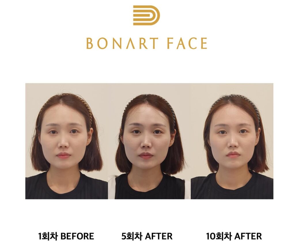 Nắn chỉnh mặt Bonart Face là phương pháp đem lại hiệu quả lâu dài