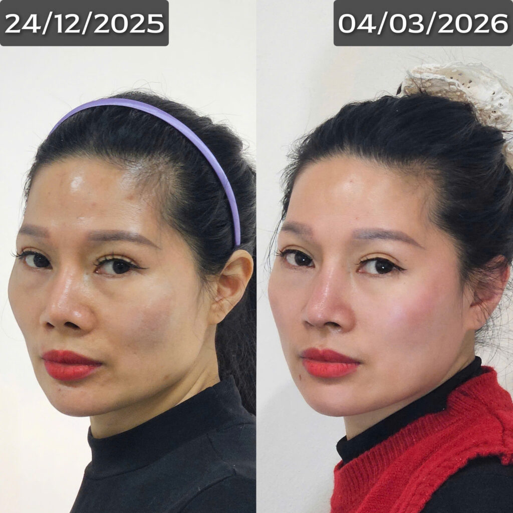 Nắn chỉnh mặt làm đẹp Bonart Face 