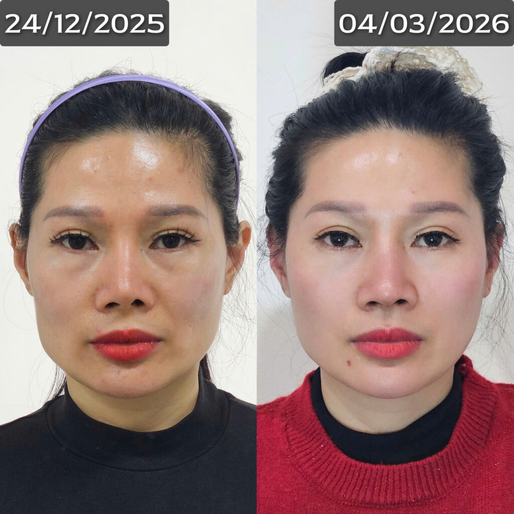 Nhiều khách hàng đã review phương pháp nắn chỉnh mặt Bonart Face sau khi thực hiện liệu trình 