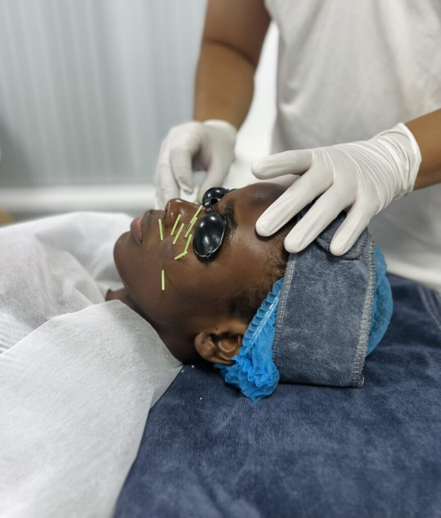 Châm cứu mặt là phương pháp mà khách quốc tế rất ưa chuộng
