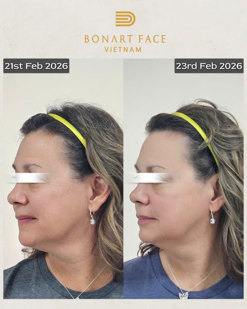 nắn chỉnh mặt trị liệu Bonart Face hiệu quả
