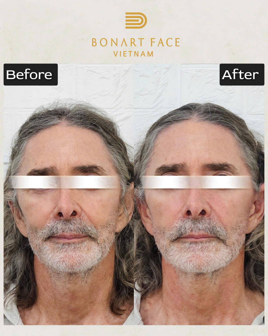 Khách hàng Bonart Face bị ù tai lâu năm